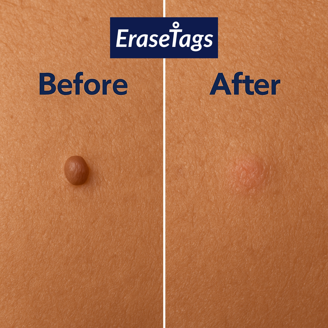 What Are Skin Tags? Causes, Myths & Safety!