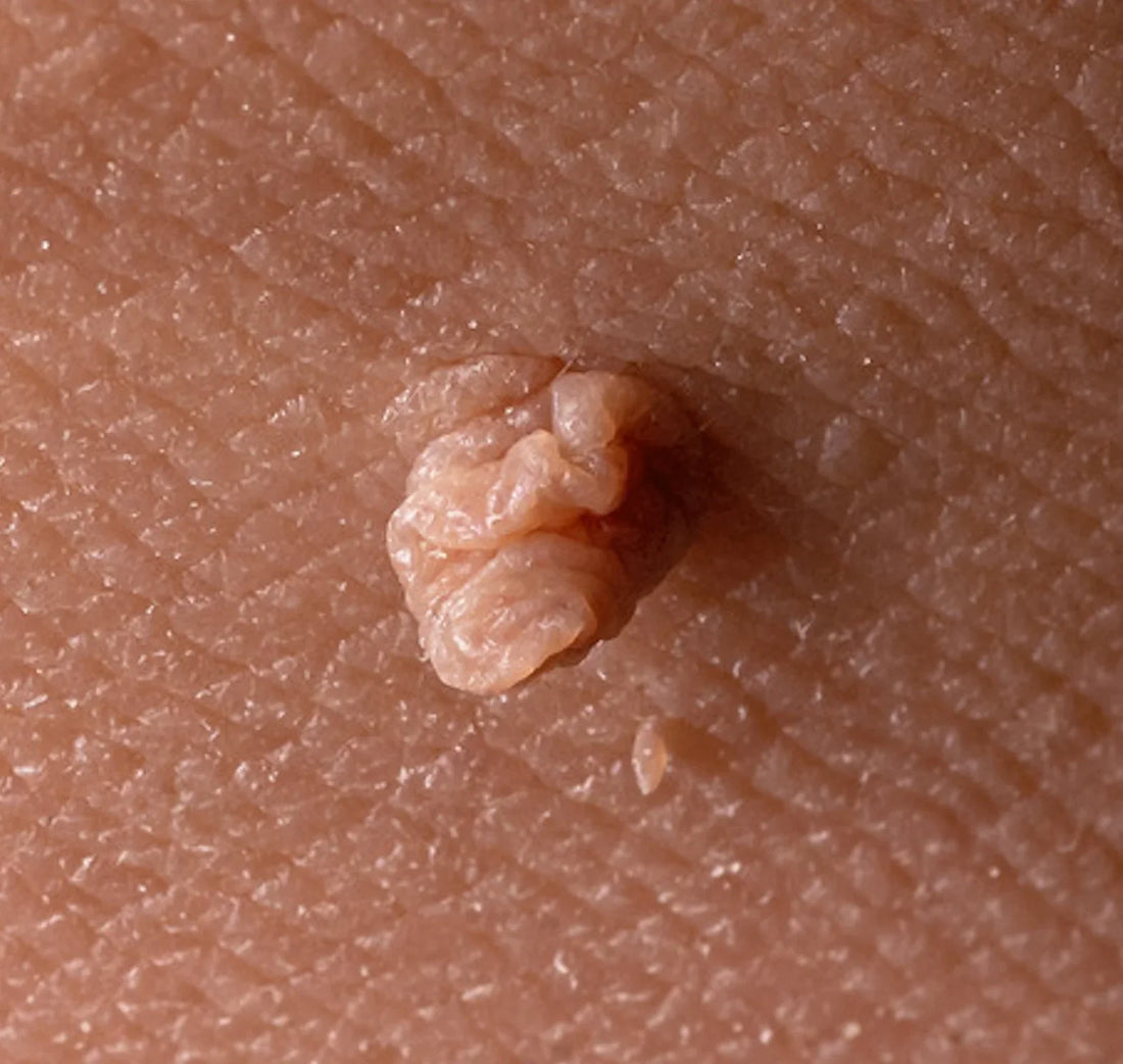 5 Reasons Why You Shouldn’t Ignore Skin Tags