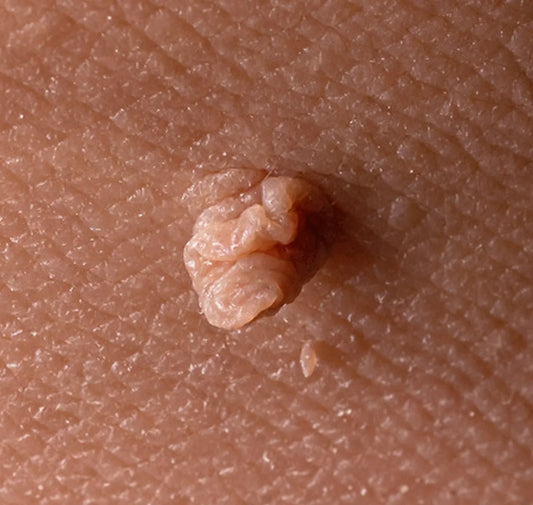5 Reasons Why You Shouldn’t Ignore Skin Tags