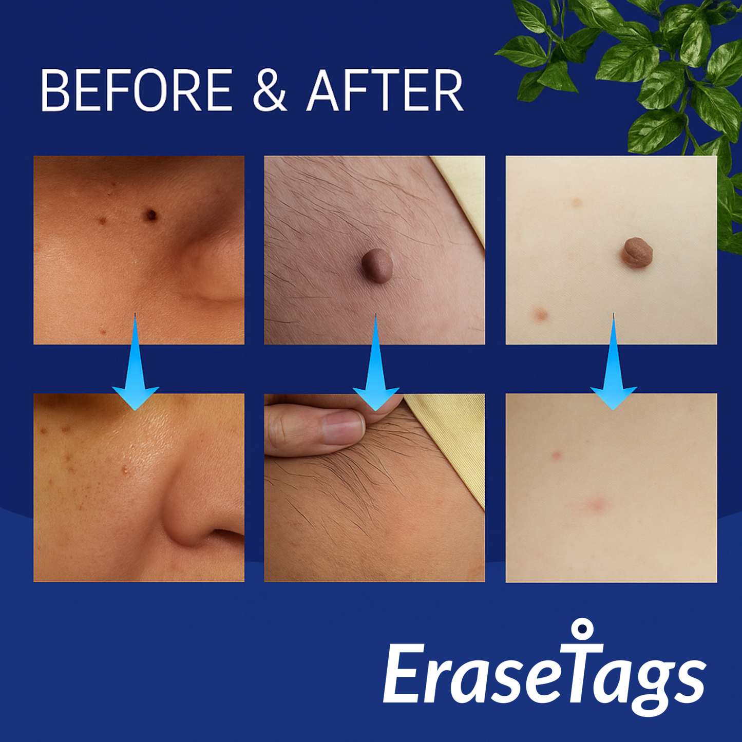 EraseTags™ | No More Skin Tags